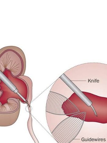 Endopyelotomy