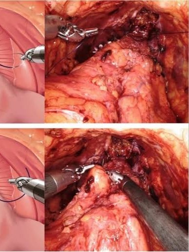 Endoscopic Suspension of Bladder Neck (for Stress Incontinance)