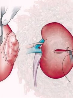 Uro-oncological Surgery