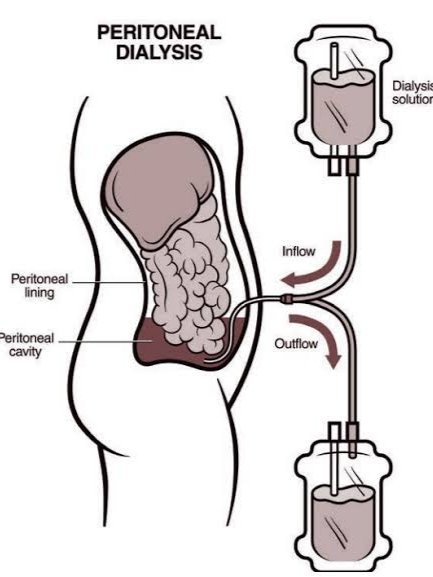 Peritoneal Dialysis