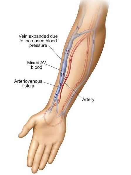 Arterio-Venous (A-V) Fistula Formation