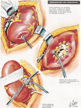 Open Stone Surgery (Including Anatrophic Nephrotithotomy)