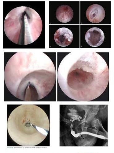 Internal Optical Urethrotomy (IOU)